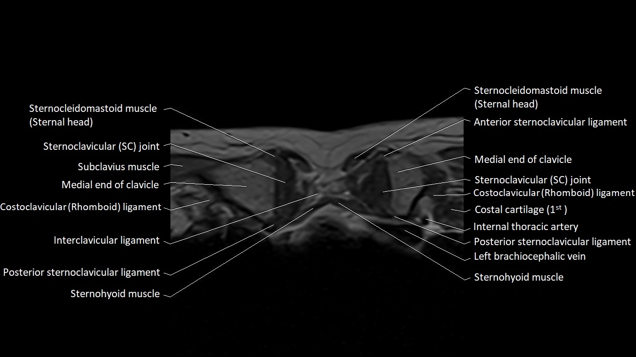 MRI sternum and sternoclavicular joint labeled axial anatomy image 4.webp